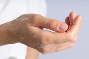 skin damaged due to winter