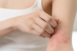woman itching on her arm have a red rash from allergy symptom and from scratching
